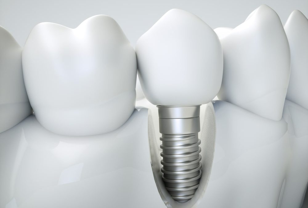 Les implants dentaires : la solution idéale pour remplacer des dents manquantes