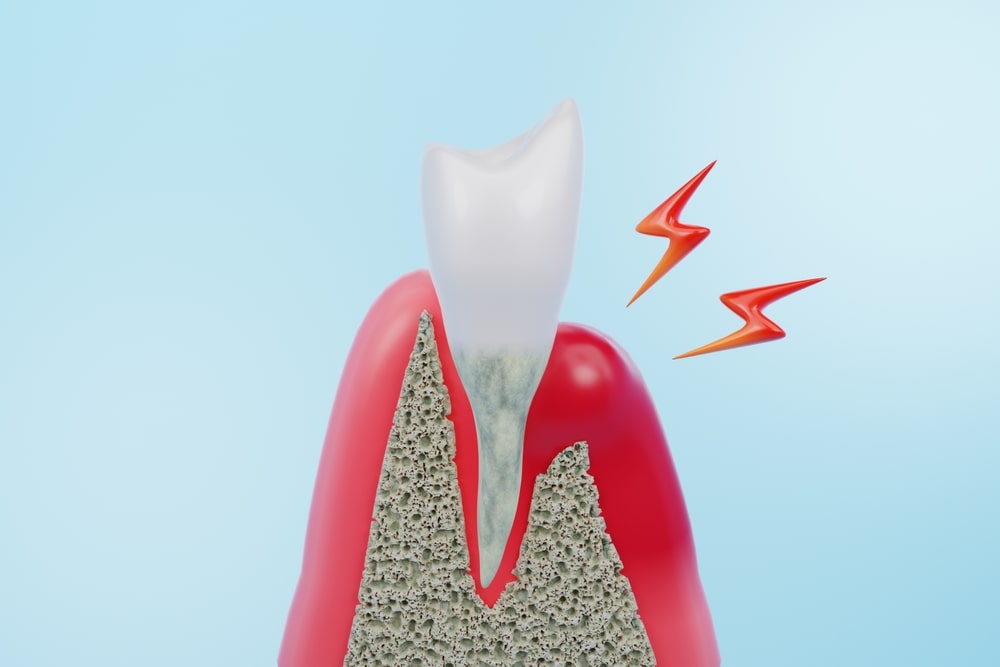 Une illustration d'un problème gingival nécessitant une greffe de gencive