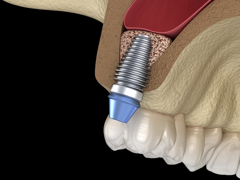 Une élévation sinusale et un implant dentaire