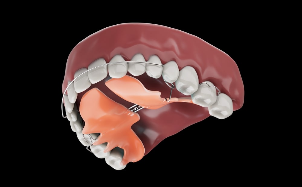 Illustration d'un appareil d'expansion palatine en orthodontie