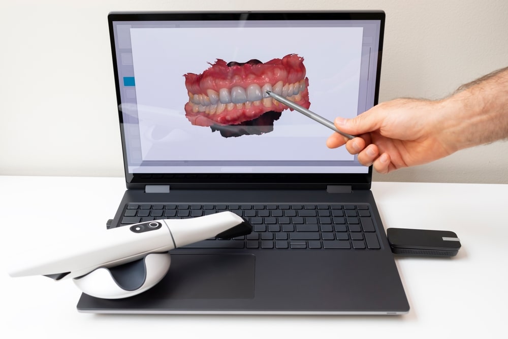Les empreintes optiques permettant de faire la simulation du sourire avec Invisalign