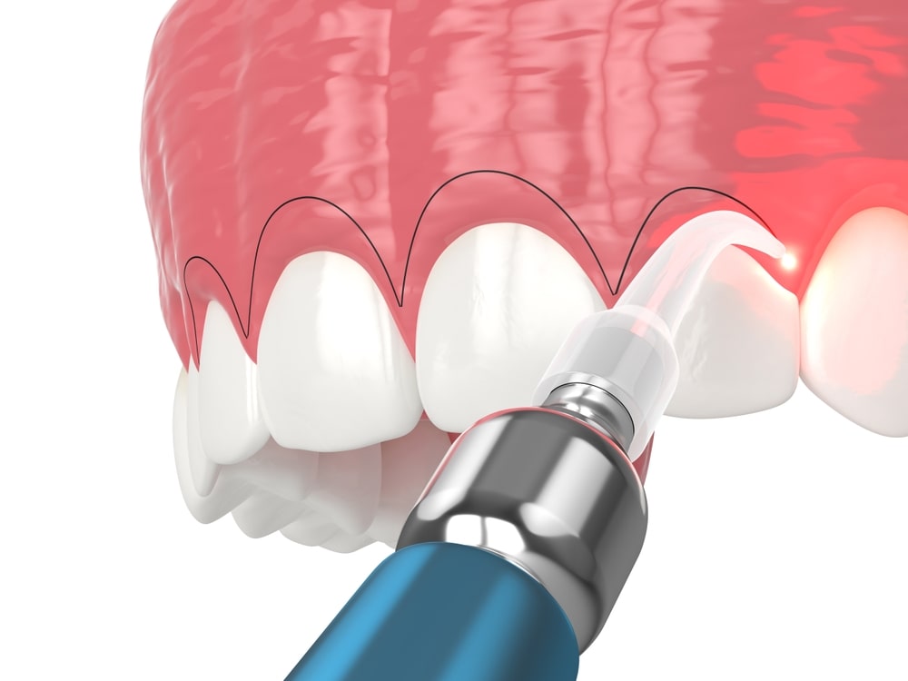Correction d'un sourire gingival avec le laser pour inciser le tissu gingival