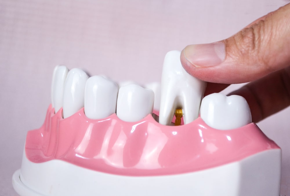 Une extraction dentaire sur un modèle