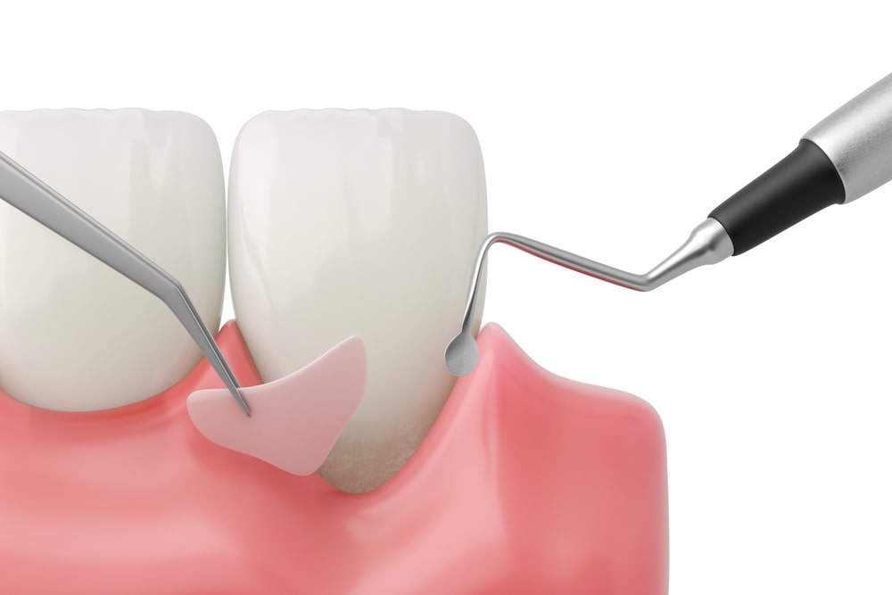Illustration 3D d'une greffe de gencive