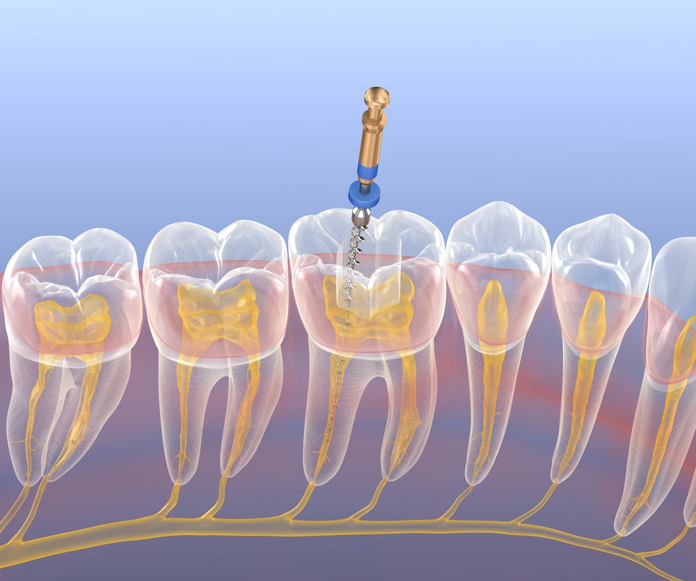Illustration de la micro-endodontie