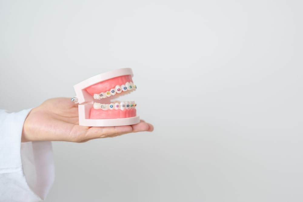 Un modèle d'orthodontie avec des broches fixes