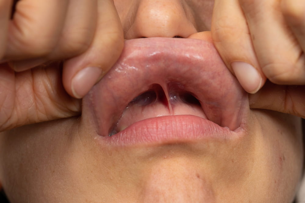 Le frein linguale peut être visé par la frénectomie